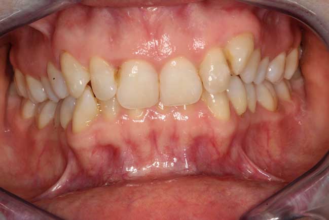 tænder før behandling med Invisalign
